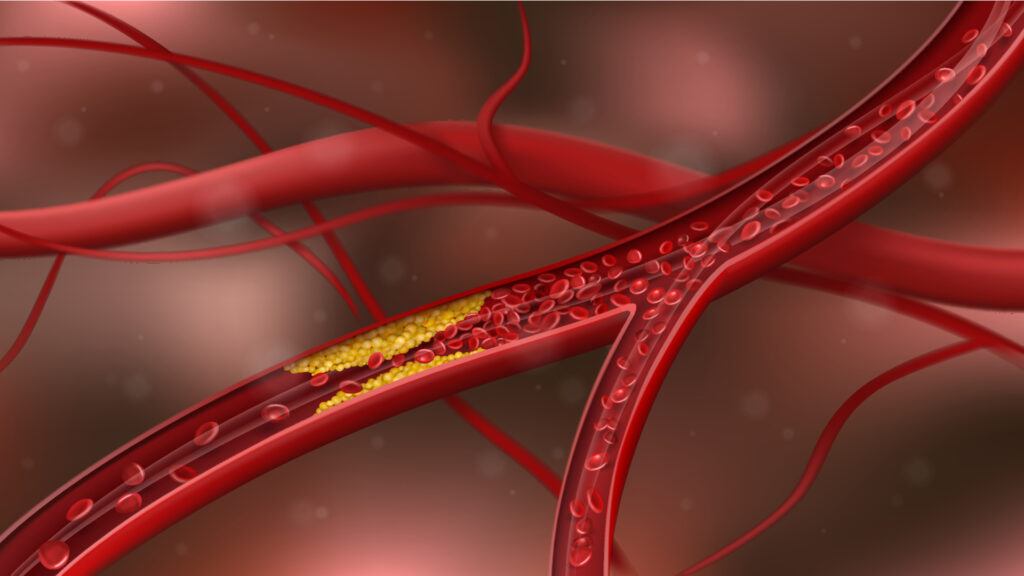 HDL Cholesterol Kits Industry