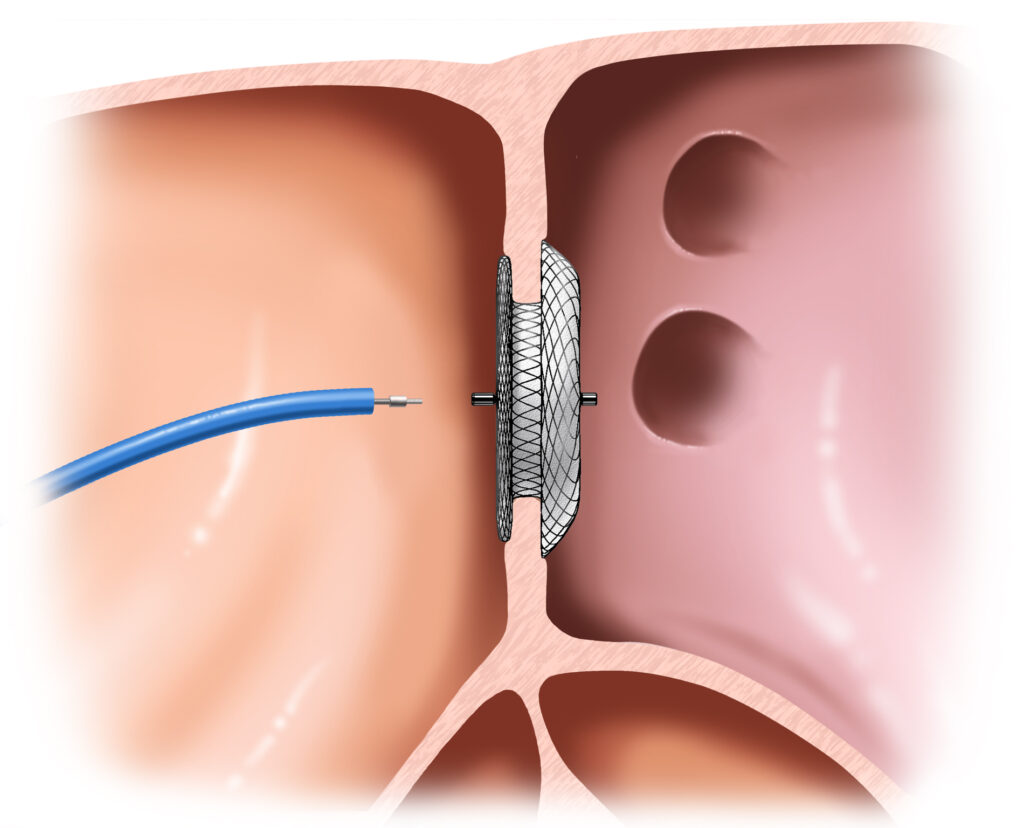 Heart Closure Devices Market