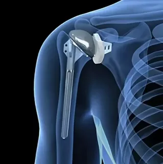 Humeral Implants Market