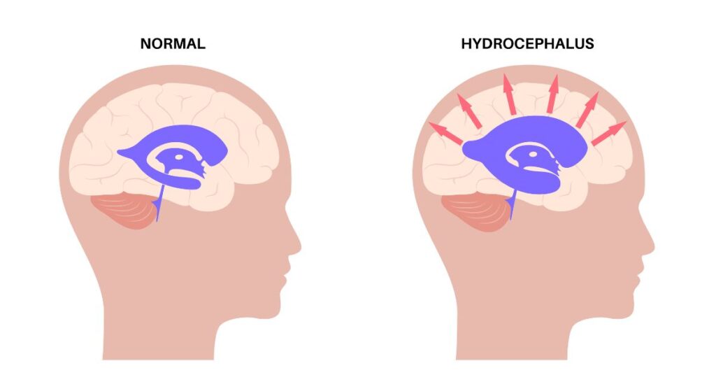 Hydrocephalus Shunt Market