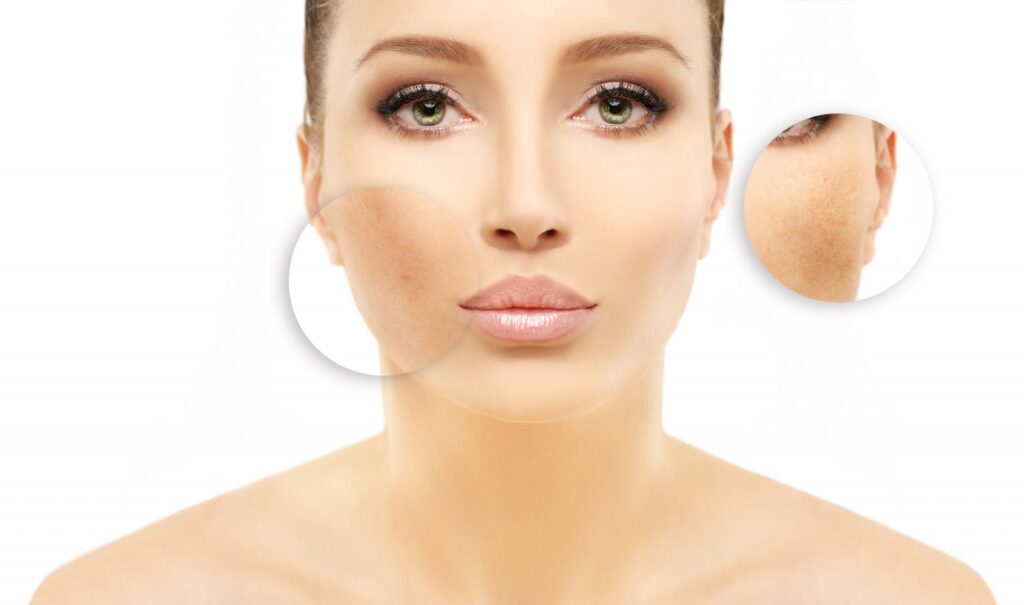 Hyperpigmentation Treatment Market