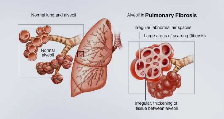 Idiopathic Pulmonary Fibrosis Management Market