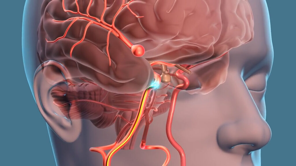 Intracranial Aneurysm Industry