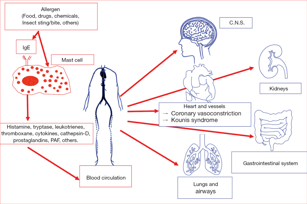 Kounis Syndrome Industry