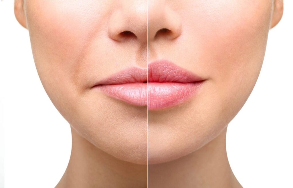 Lip Fillers Industry