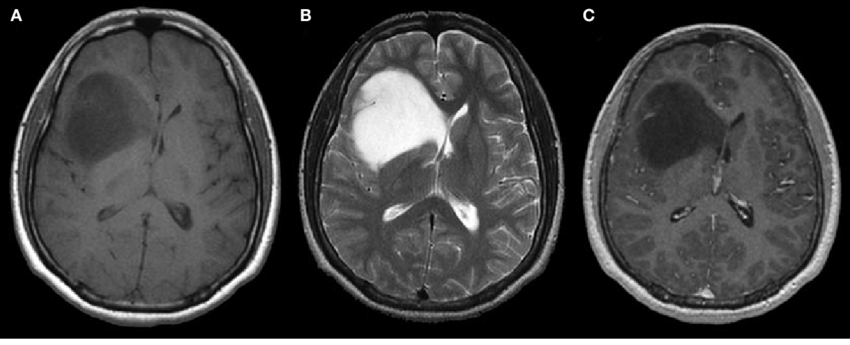 Low-Grade Glioma Therapeutics Industry