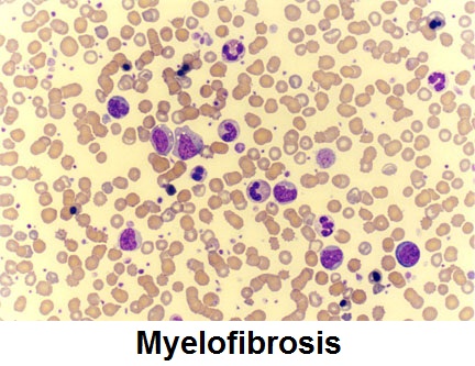 Myelofibrosis (MF) Treatment Market