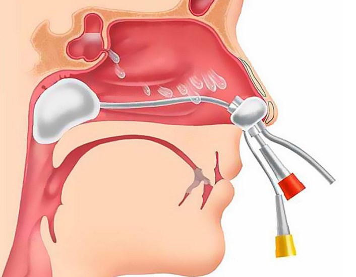 Nasal Packing Devices Industry