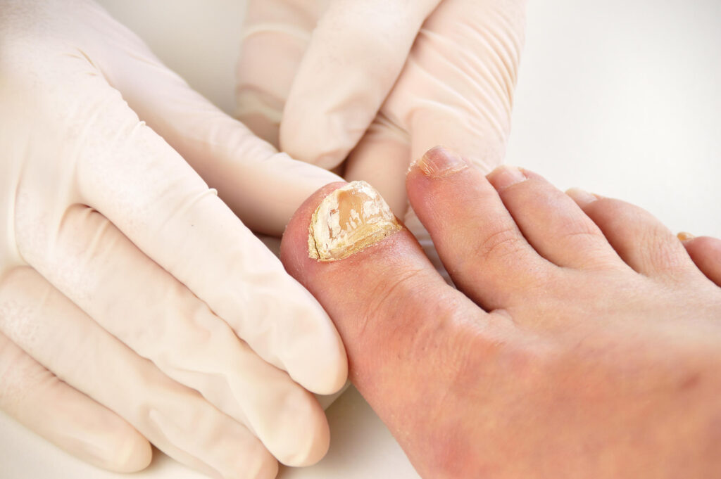 Onychomycosis Treatment Market