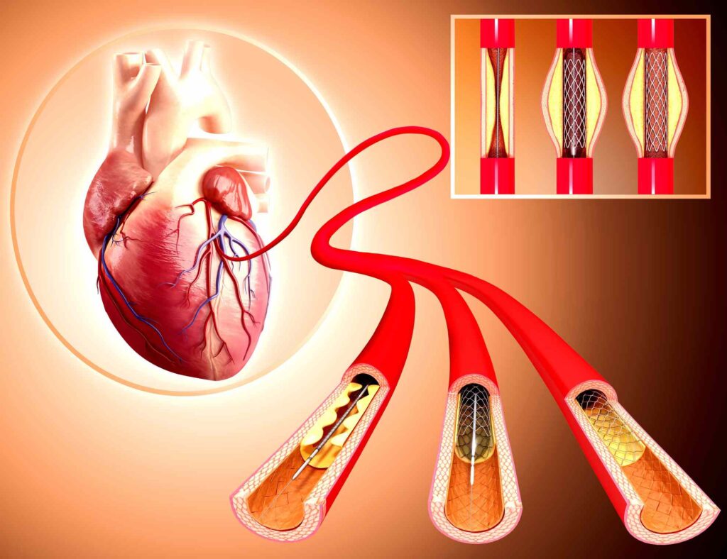 Peripheral Angioplasty Market