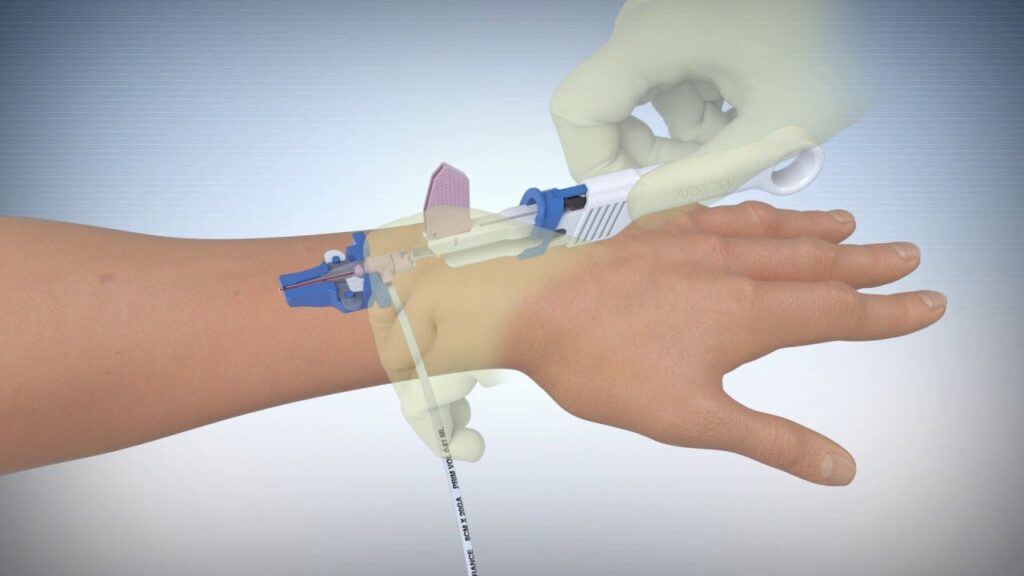 Peripheral Intravenous Catheters Market