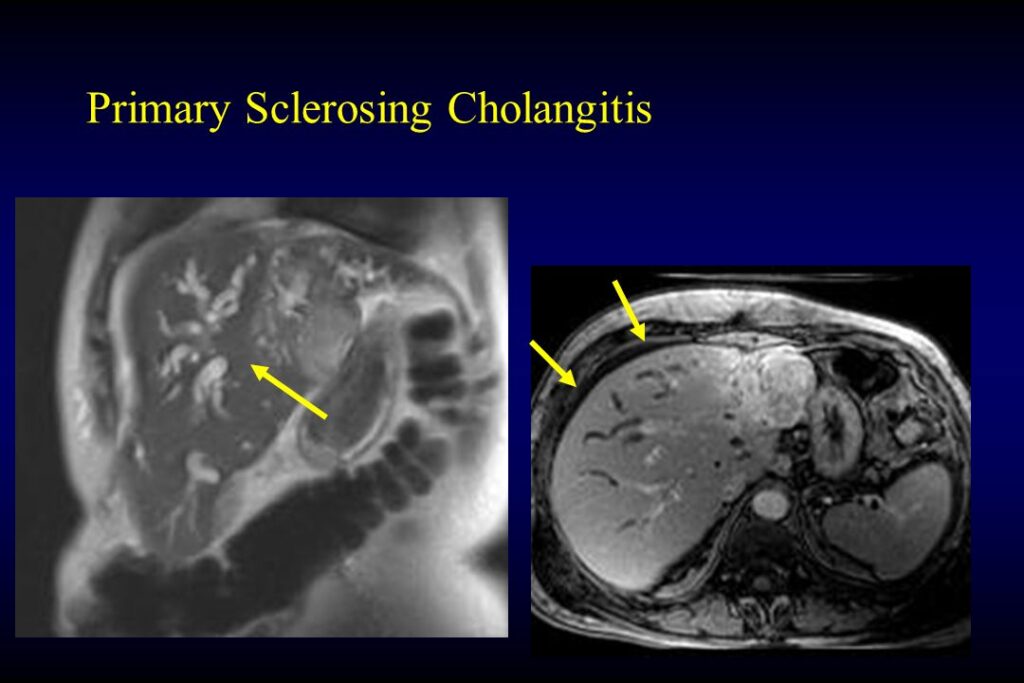 Primary Sclerosing Cholangitis (PSC) Market