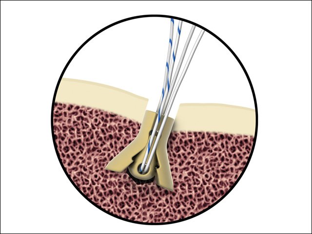 Suture Anchor Devices Industry