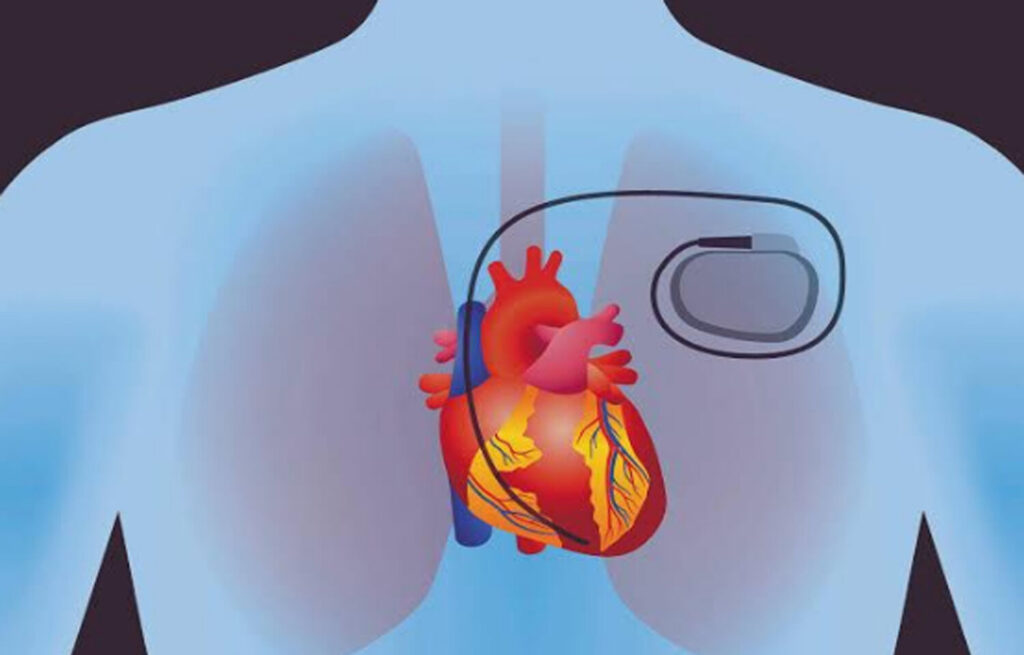 Temporary Pacing Leads Industry size