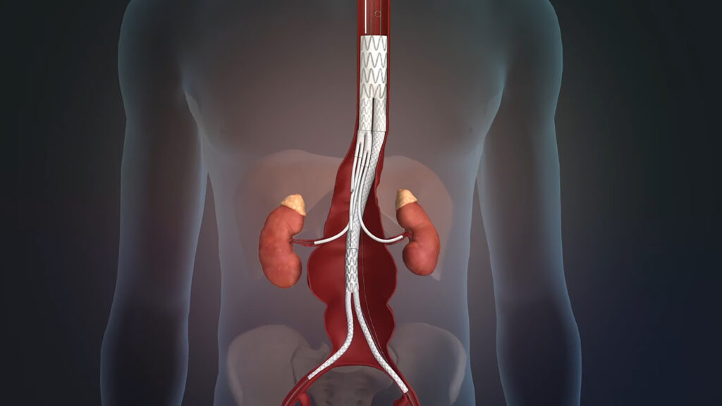 Thoracic Vascular Stent Grafts Industry