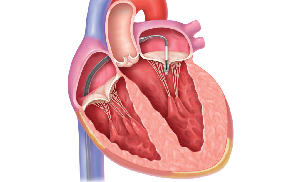 Transcatheter Mitral Valve Industry