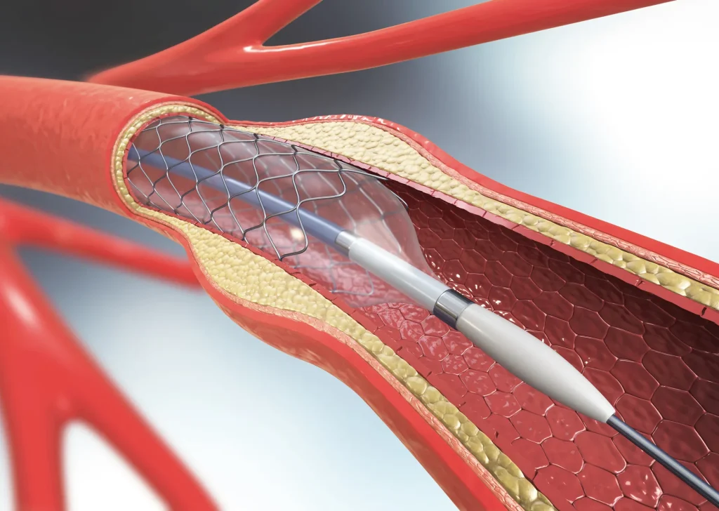 Travascular Imaging Market