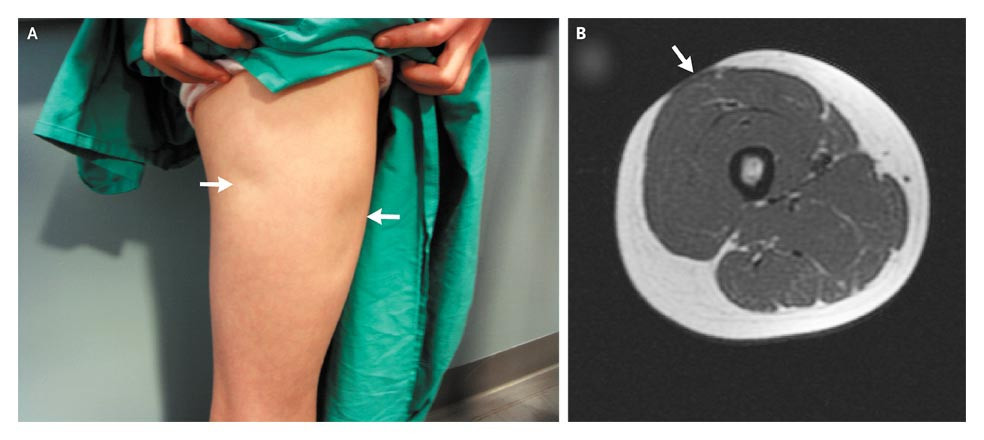 Ulcerated Necrobiosis Lipoidica Management Market