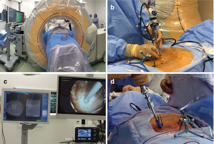 Unilateral Biportal Endoscopy Industry