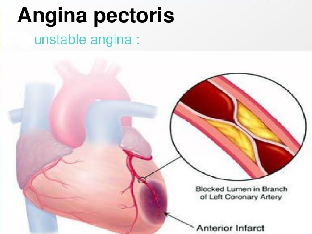 Unstable Angina Therapeutics Market