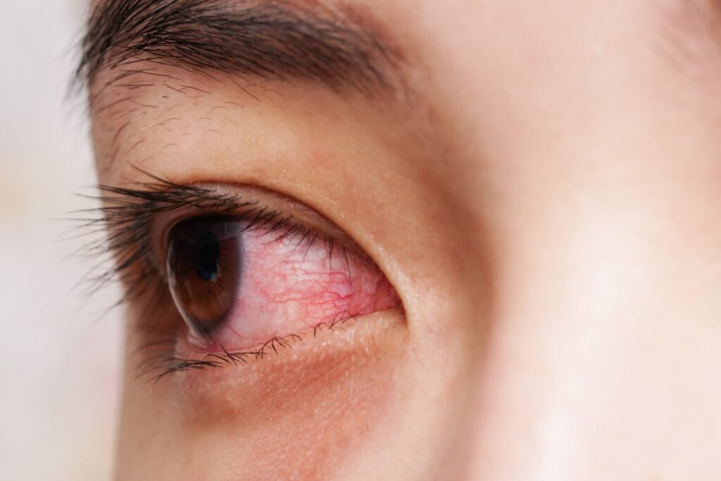 Vernal Keratoconjunctivitis Market