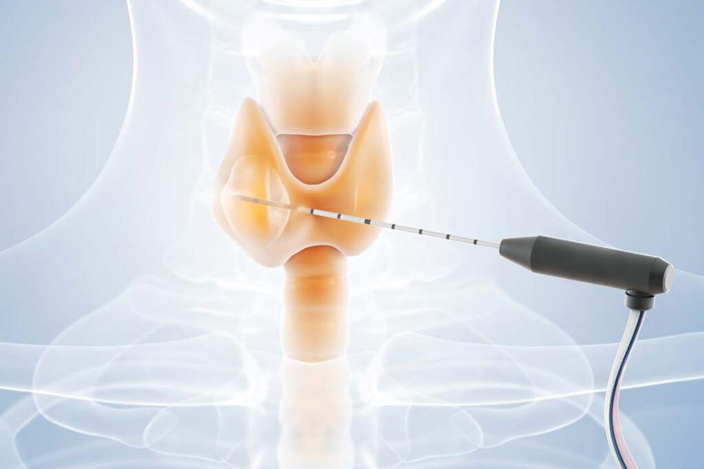 Ablation Devices Market