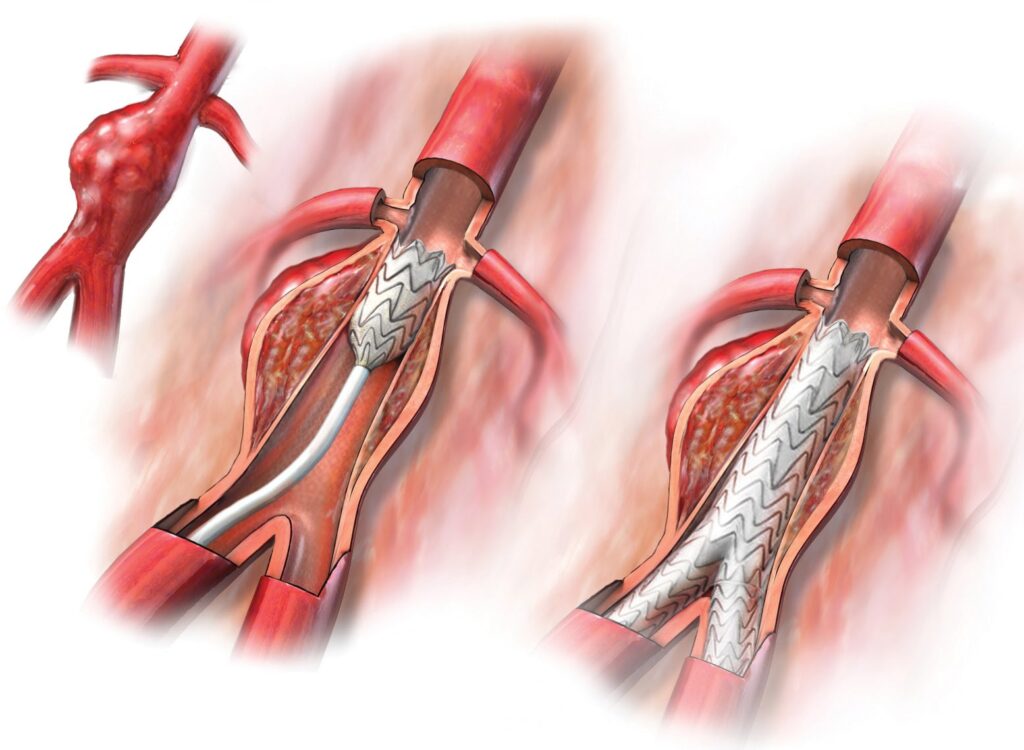 Aortic Stents Grafts Propel Market