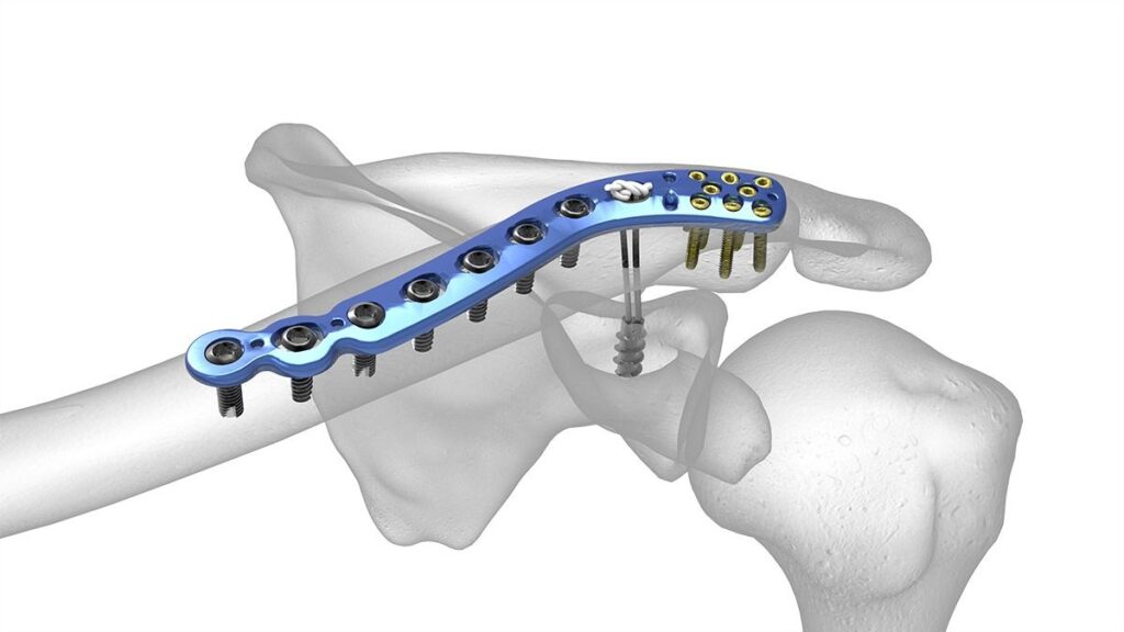 Bone Screw System Industry