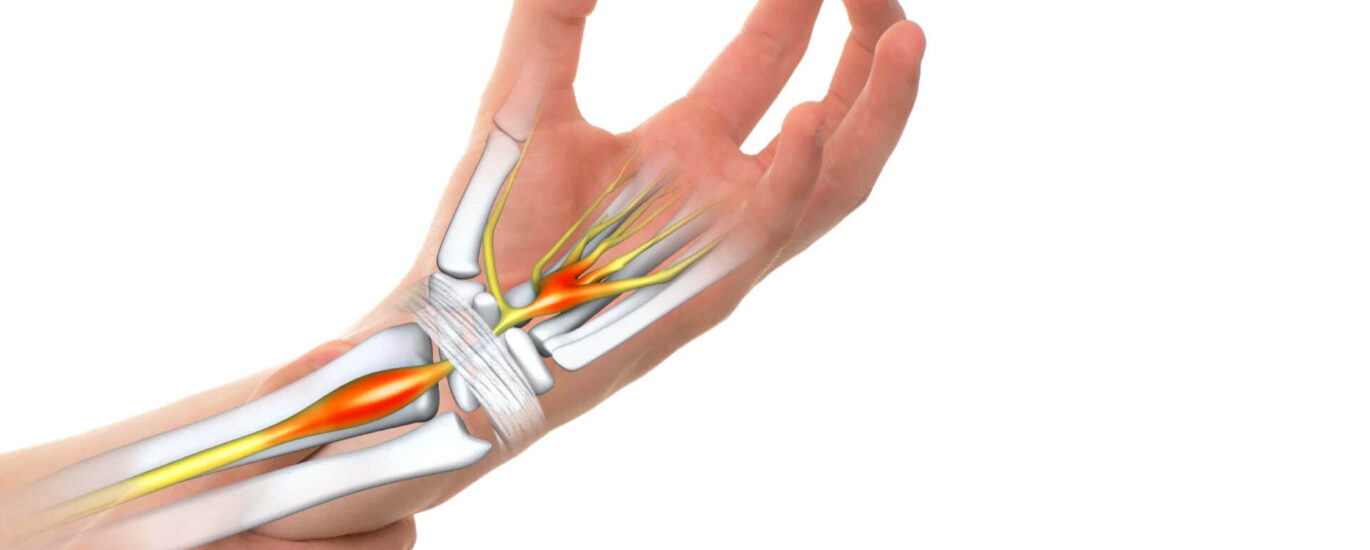 Global Carpal Tunnel Release Systems Industry