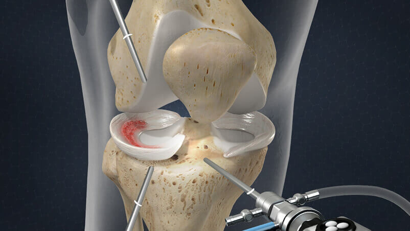 Cartilage Repair Industry