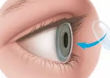 Global Corneal Ulcer Treatment Industry