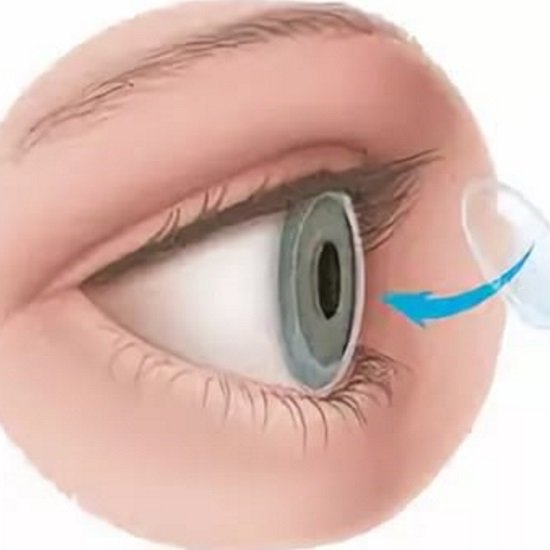 Global Corneal Ulcer Treatment Industry