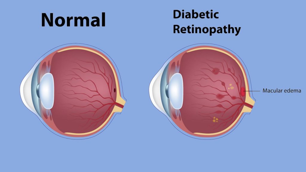 Diabetic Macular Edema Industry