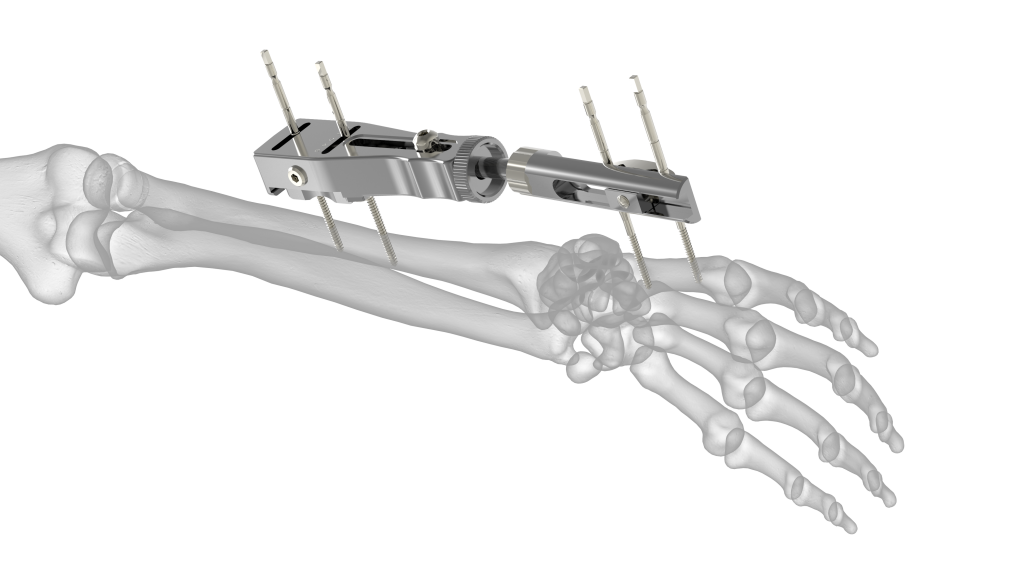 External Fixators Market