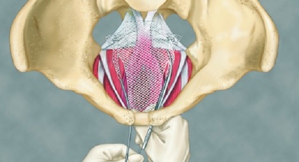 Female Pelvic Implants Industry