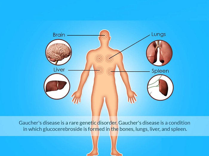 Gaucher and Pompe Diseases Enzyme Replacement Therapy (ERT) Industry