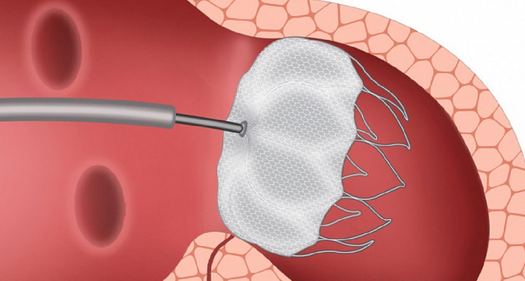 Global Atrial Appendage Occluder Industry