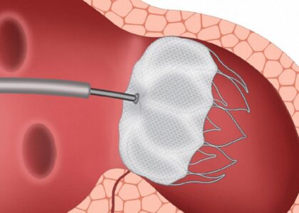 Global Atrial Appendage Occluder Industry