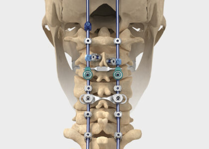 Global Cervical Spacer Systems Industry