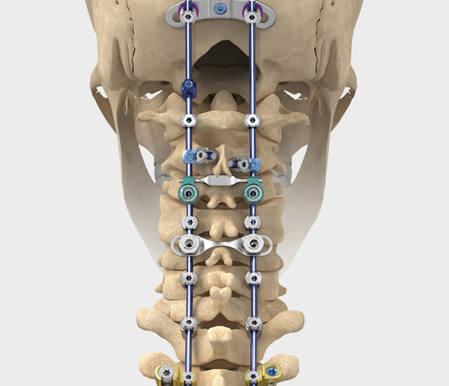 Global Cervical Spacer Systems Industry