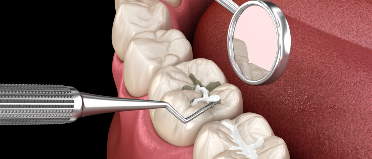 Global Dental Sealants Industry