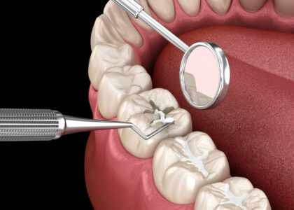 Global Dental Sealants Industry