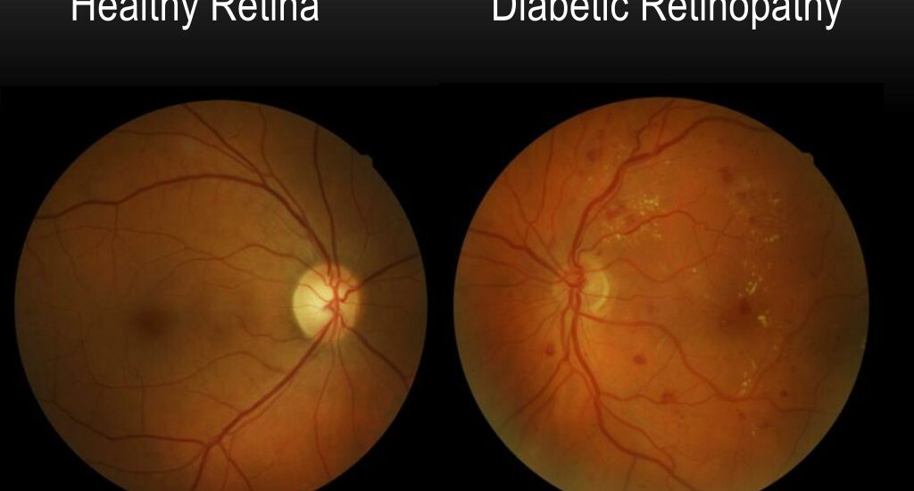 Global Diabetic Retinopathy Industry