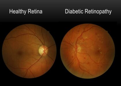 Global Diabetic Retinopathy Industry