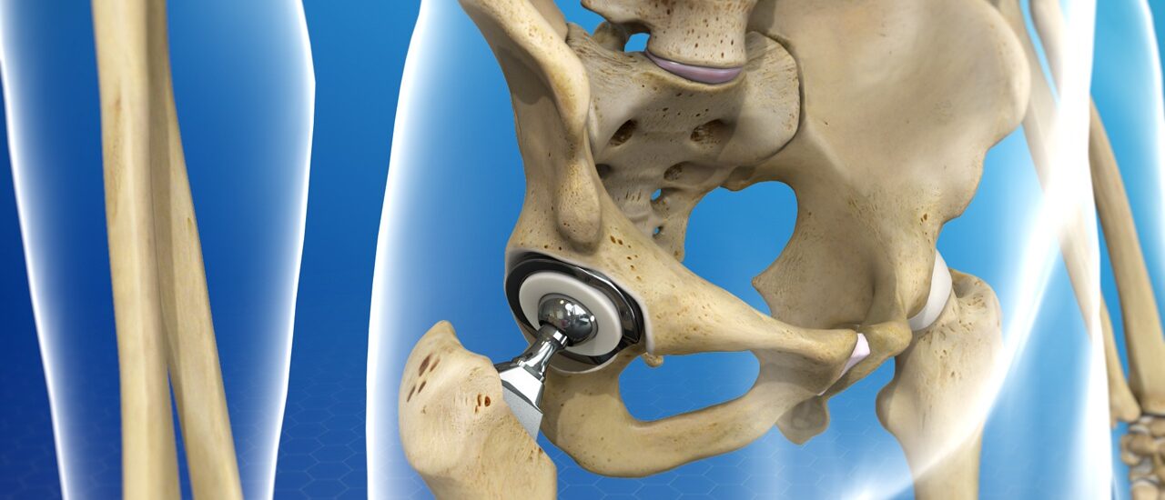 Global Pelvic Reconstruction Industry