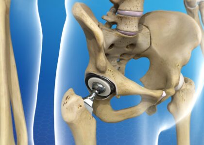 Global Pelvic Reconstruction Industry