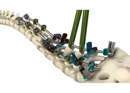 Global Thoracolumbar Stabilization Devices Industry