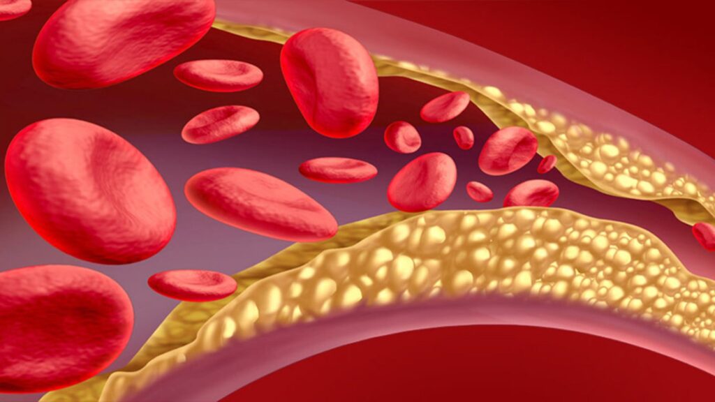 HDL Cholesterol Kits Industry