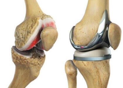 Global Knee Replacement Industry