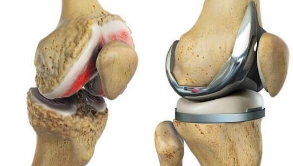 Global Knee Replacement Industry